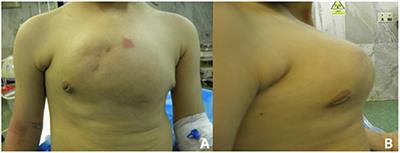 Reconstruction of Chest Wall by Cryopreserved Sternum Allograft After Resection of Sternal Hemangioma: A Case Report